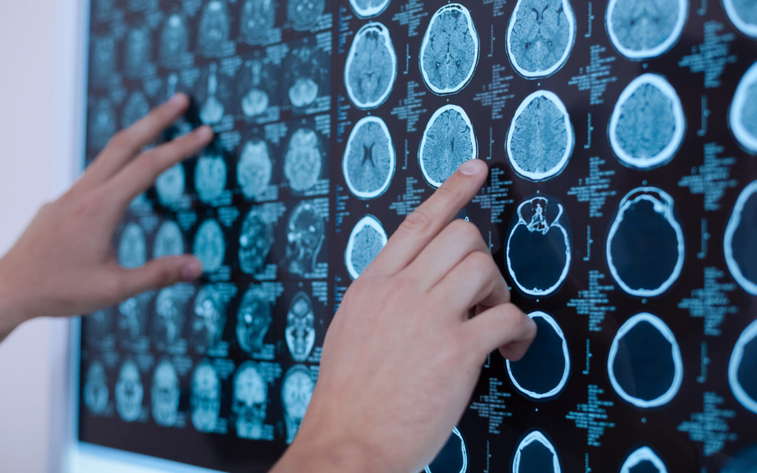 Can You Suffer A Brain Injury Without Losing Consciousness?