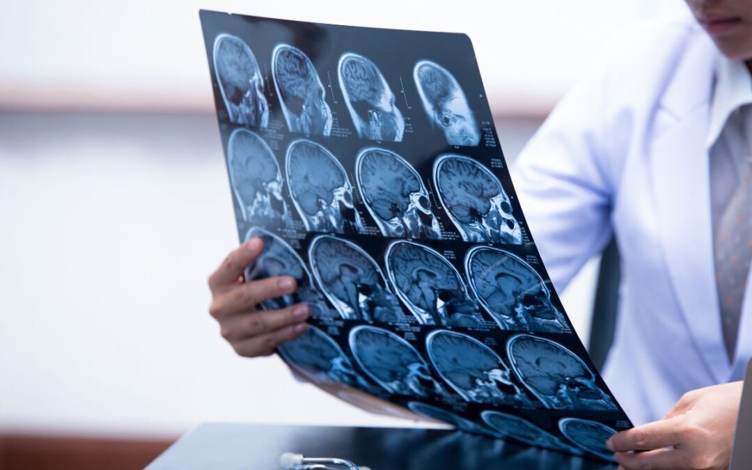 Signs of Concussion After a Traumatic Brain Injury