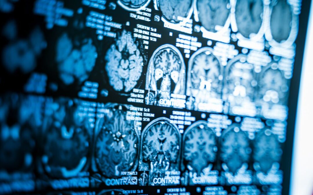 A Game-Changing New Brain Injury Test Has Been Authorized