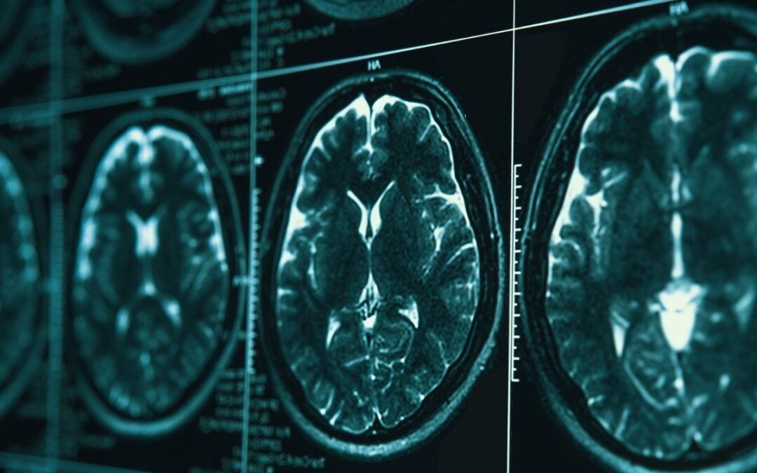 Traumatic Brain Injuries Linked to Increase Stroke Risk
