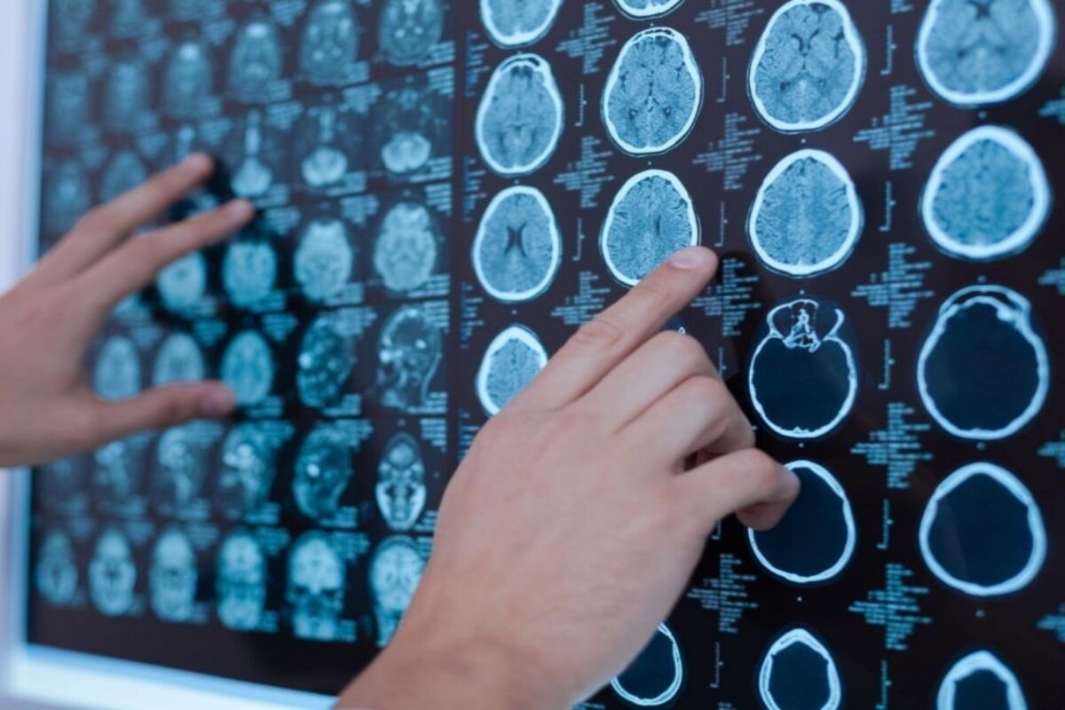What Does the First Year of Recovery Look Like for TBI Patients?