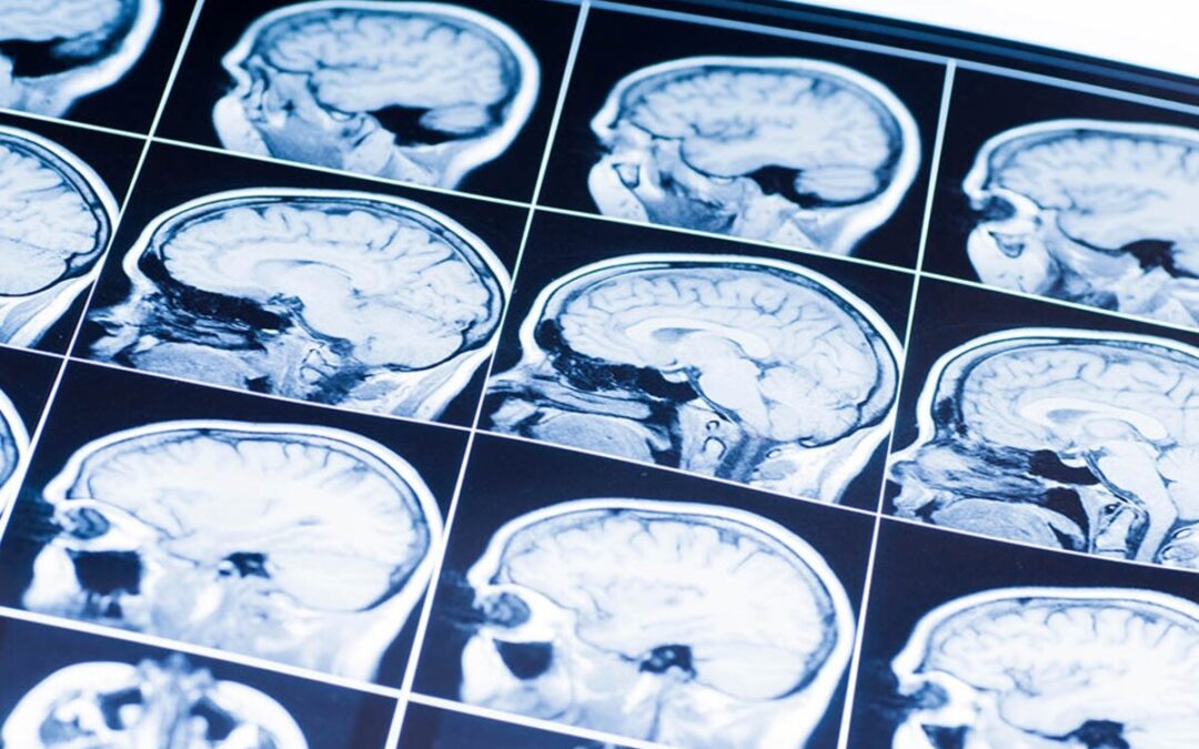 Preventing Seizures After a TBI Could Slow or Prevent Dementia