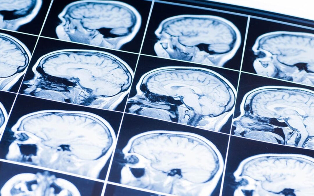 traumatic brain injury case